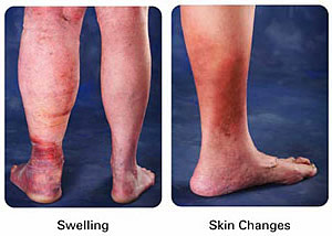 Leg Edema Treatment Austin - Leg Ankle Foot Swelling Therapy